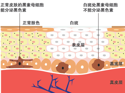 白癜风能治好吗_早期白癜风能不能治好_海南治疗皮肤病医院